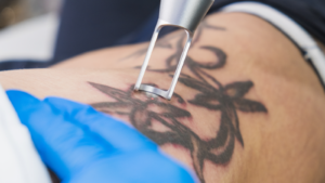 Cómo funciona eliminación de tatuajes con láser