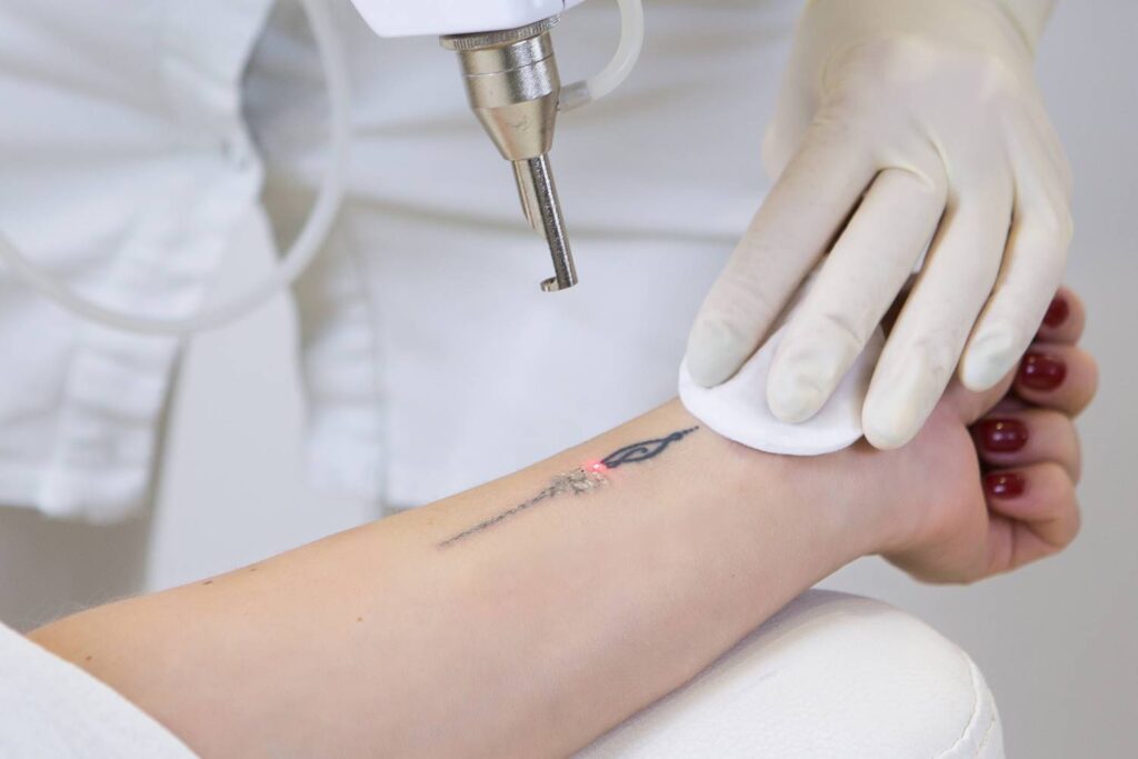 Cómo funciona la eliminación de tatuajes con láser