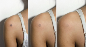 eliminar tatuajes murcia