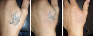 funciona la eliminación de tatuajes con láser