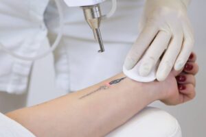 como funciona eliminacion tatuajes