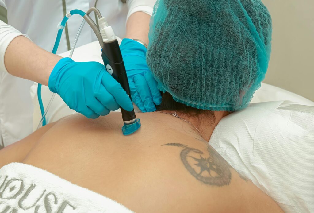 Cómo funciona la eliminación de tatuajes con láser